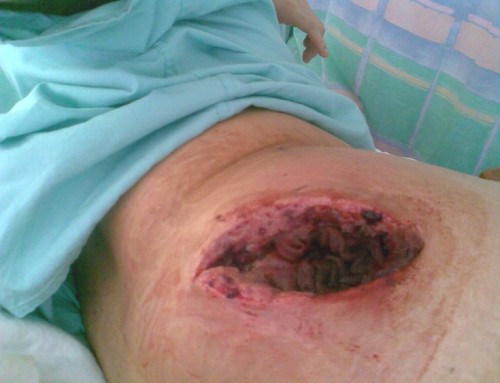 The wound packed with sterile packing to absorb tissue exudate