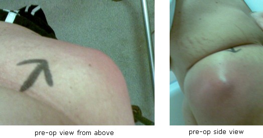 Glute abscess side and top view